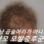 양모 모발증후군 증상 원인 치료 방법 (양털 모발증후군 울리헤어 증후군)
