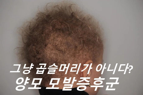 양모 모발증후군 증상 원인 치료 방법 (양털 모발증후군 울리헤어 증후군)