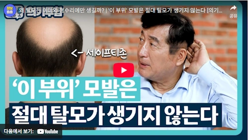 왜 탈모는 이마와 정수리에만 생길까