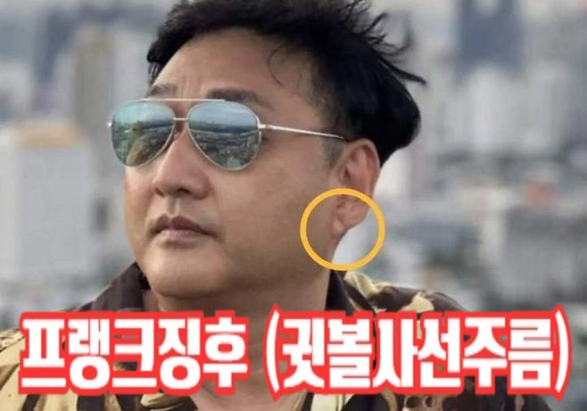 심정지 돌연사 부르는 심혈관 이상 징후 "귓볼 사선 주름 프랭크징후" 자세히 알아보자! 귓볼 사선 주름 프랭크 징후 뭐길래 (ft. 이경규 김수용 사망할뻔 심혈관 이상 징조)