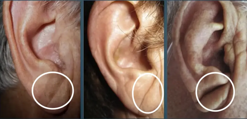 심정지 돌연사 부르는 심혈관 이상 징후 "귓볼 사선 주름 프랭크징후" 자세히 알아보자! 프랭크징후 (귓볼사선주름)