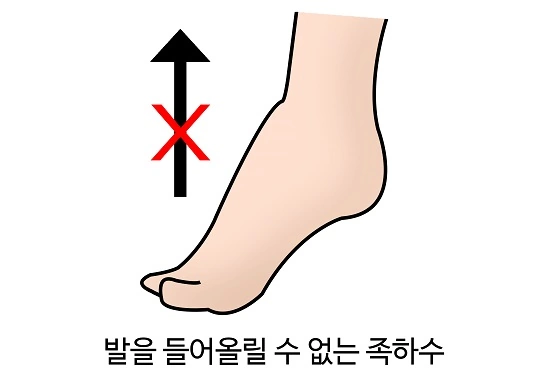 서서히 손발 감각을 잃는 샤르코 마리 투스병 증상 원인 치료법 (삼성 이부진 유전병 & 건강) 샤르코 마르투스병 증상 족하수