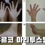 서서히 손발 감각을 잃는 샤르코 마리 투스병 증상 원인 치료법 (삼성 이부진 유전병 & 건강) 서서히 손발 감각을 잃는 샤르코 마리 투스병 증상 원인 치료법 (삼성 이부진 유전병 & 건강)