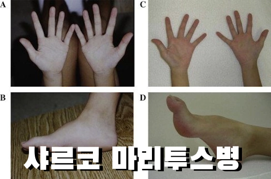 서서히 손발 감각을 잃는 샤르코 마리 투스병 증상 원인 치료법 (삼성 이부진 유전병 & 건강) 서서히 손발 감각을 잃는 샤르코 마리 투스병 증상 원인 치료법 (삼성 이부진 유전병 & 건강)